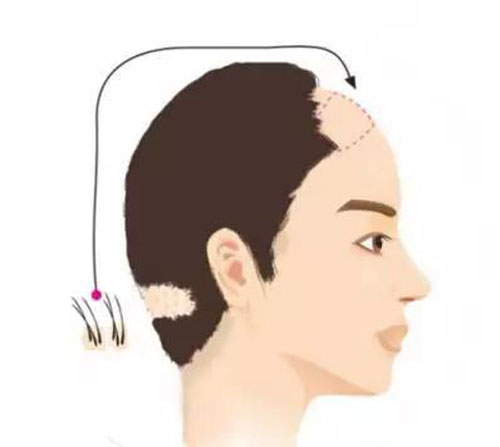 种植头发手术是将后枕部健康毛囊提取出来后，在移植到脱发区域