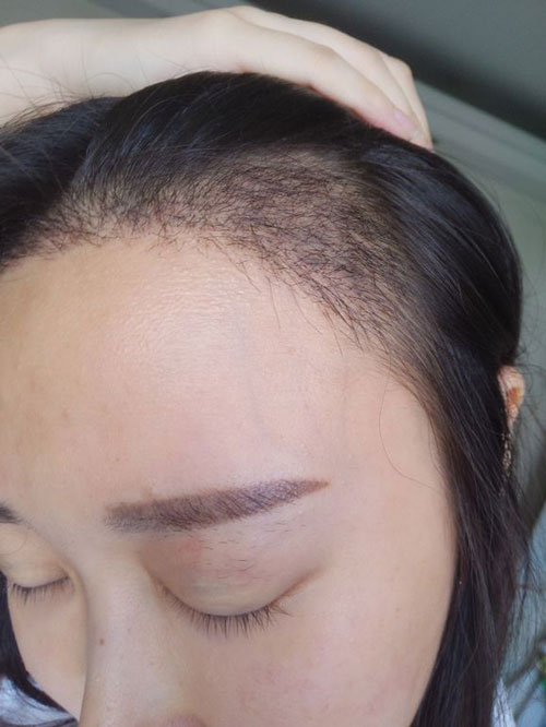 种植头发术后30天的种植头发效果