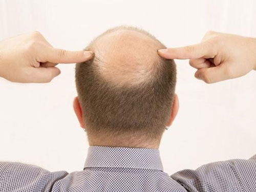 男性脱发原因有哪些?如何改善脱发问题?