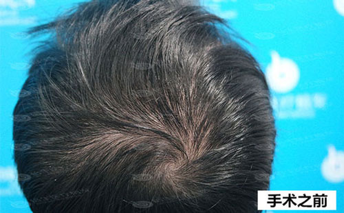 M型脱发种植头发前后枕区情况