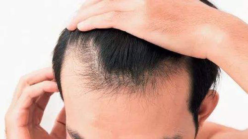 广州种植头发医院种植头发时怎么设计种植头发方案的？