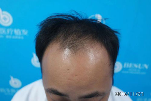 种植头发前如何选择广州种植头发医院?