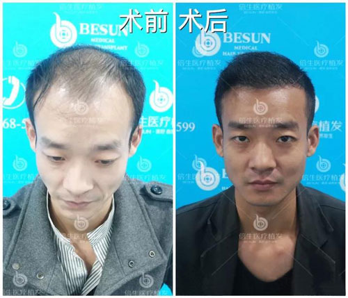 广州哪家医院种植头发效果好?