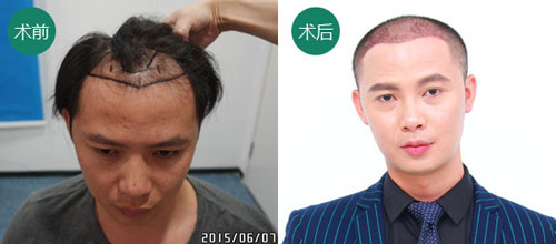 广州SEP种植头发技术适合男人吗？