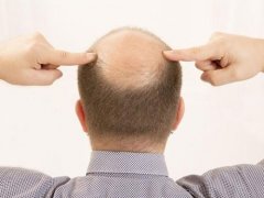 头发加密能拯救头顶发量稀疏吗？