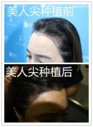广州美人尖种植怎么做，广州哪家植发医院比较好