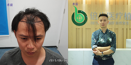 广州倍生种植头发医院