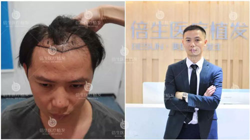 广州种植头发价格多少钱合适？