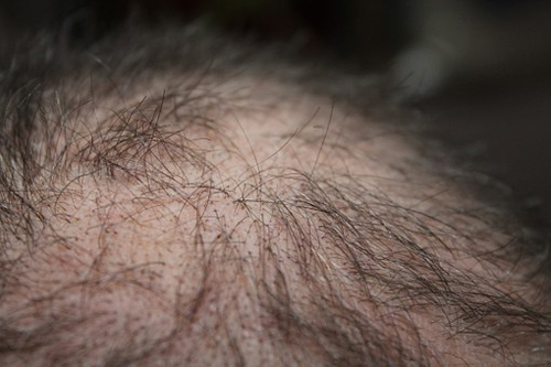 广州倍生种植头发技术,让头发种植密度大大提高