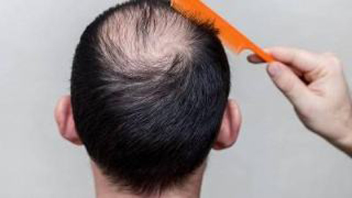 广州种植头发医生杨晓谈头发种植,头发不是你想植就能植的