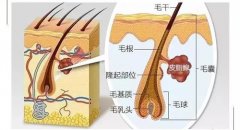 广州毛发种植手术成功的三大保障你知道吗​