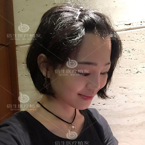 广州倍生种植头发的发际线调整手术如何，看看她们就知道了