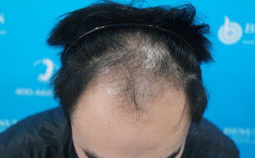 为什么发际线调整要用瑞士nature（NAT）美学种植头发术？