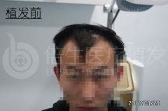 【植发案例】广州倍生植发医院治好了我的脂溢性脱发