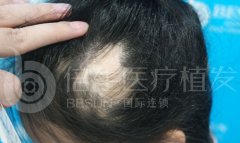 疤痕上种植头发可以吗，倍生植发FHP加密技术搞定他