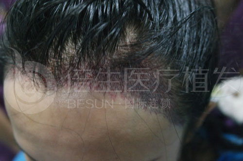 广州种植头发2000单位毛囊费用3万靠谱吗？