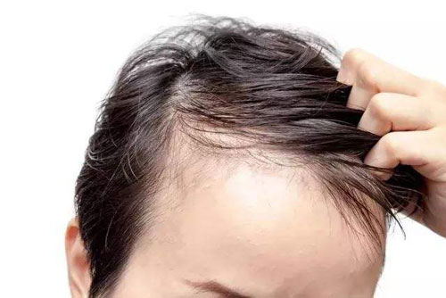 胡志奇谈脱发：脱发影响年轻人的心理健康，年轻人需正视种植头发