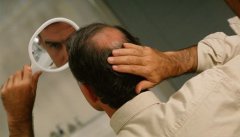 倍生植发专家实力科普：男性不仅易秃，还会早秃