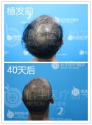 广州种头发哪家医院最好，看倍生植发案例及效果反馈