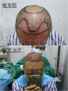 广州种植头发的效果前后对比图