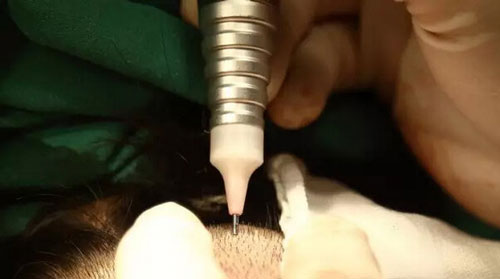 瑞士NAT美学种植头发技术