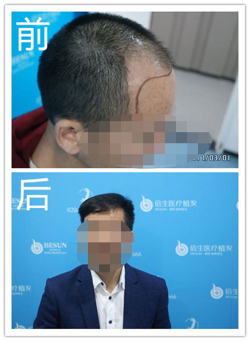 广州种植头发医院