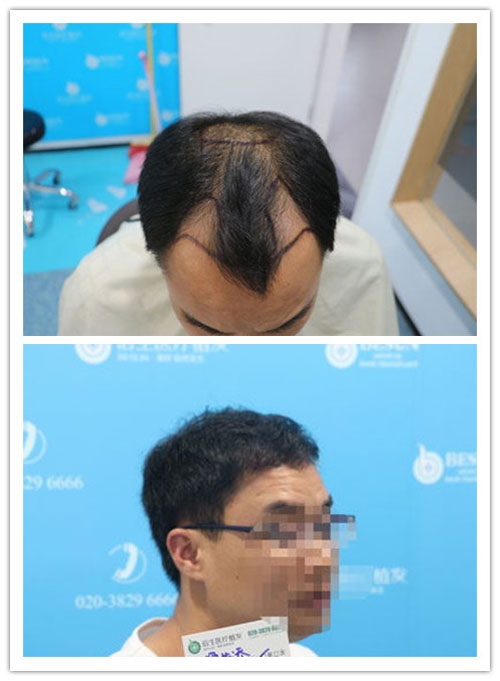 广州种植头发医院