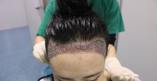 瑞士NAT美学种植头发技术