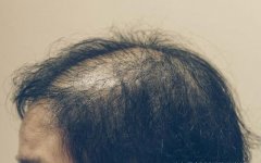 NAT美学植发专治头发稀疏问题