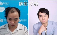 广州种头发需要多少钱?