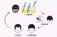 广州最好的植发技术有哪些特征